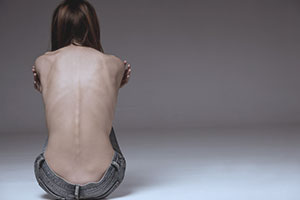 woman with back to camera, bones evident under skin with anorexia eating disorder